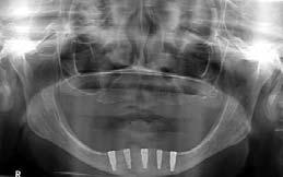 Five implants were placed between the mental foramina in the mandible, maximizing