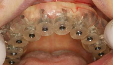 10 implants with healing abutments after a 6 month healing period exhibiting