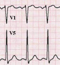 Advanced Pathophysiology Unit 5 CV Page 24 of 24 Left ventricular hypertrophy (LVH): S wave V1 + R wave V5 > 35 mm COUNT THE BOXES FOR MM ELEVATION o This is called voltage criteria for LVH o There