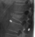 Fractures - Disk Herniation (40%) Posterior Column - Facet Jt