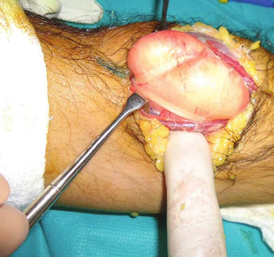 Saaiq et al. 103 Fig. 4: Intraoperative photograph showing the parosteal lipoma. The overlying stretched medial and lateral branches of the PIN are clearly visible. Fig. 5: Intraoperative photograph showing the parosteal lipoma.