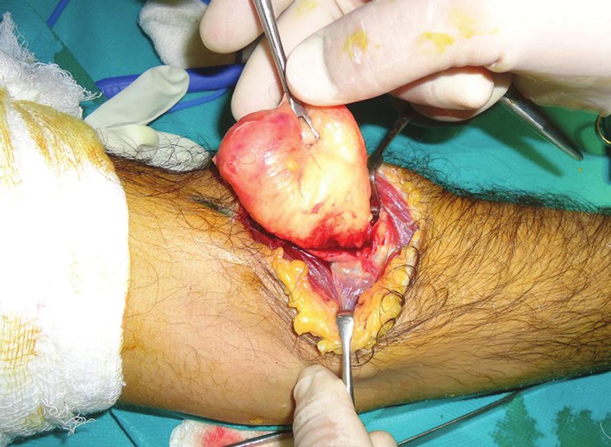 6: Intraoperative photograph after the parosteal lipoma has been excised and all potential sites of PIN compression have been released.