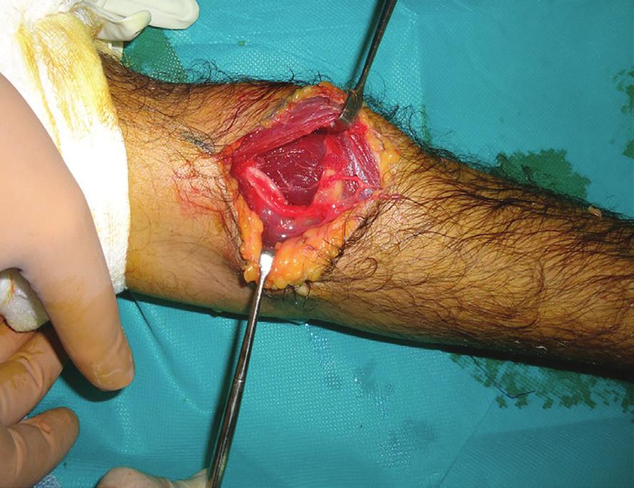 7: Photograph showing the excised parosteal lipoma specimen (measuring approximately 6 5 4 cm size) the peripheral fat component and the bony attachment site are visible.
