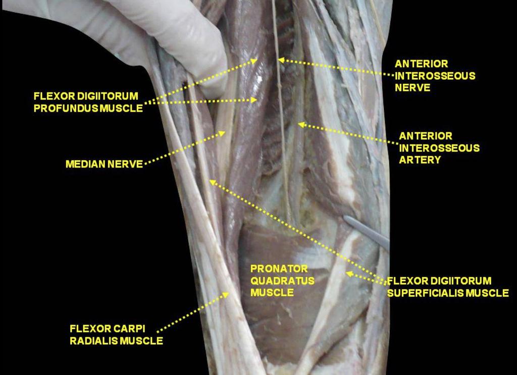 Anterior Interosseous Nerve Syndrome Anterior interosseous nerve: Innervates - Pronator