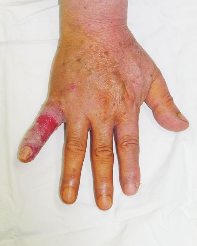 Archives of Hand and Microsurgery Vol. 23, No. 4, December 2018 ry of redness and swelling on his left little finger. He had a history of local trauma with sharp metal three months prior.