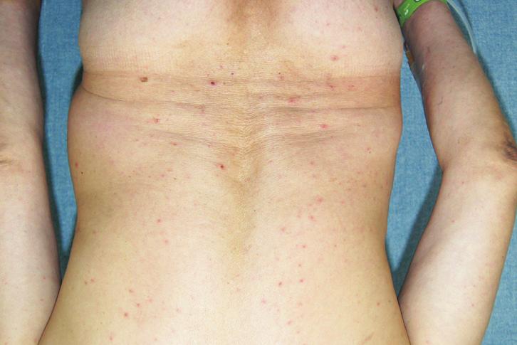 After several days, generalized skin symptoms improved progressively, and skin biopsy results indicated SSSS (Fig. 6).