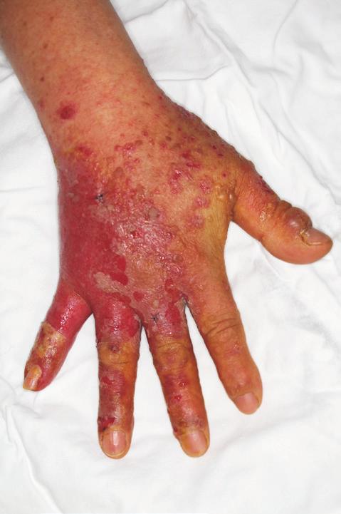 He was responding to antibiotic treatment and showed improved symptoms. Patient discharged from the hospital and returned for outpatient follow-up.