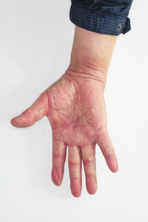 To differentiate SSSS from TEN, findings suggestive of SSSS include striking cutaneous tenderness, positive Nikolsky sign, and lack of mucosal involvement.