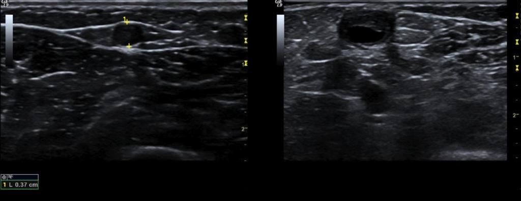 Another patient with an occluded radial cephalic fistula presenting for vascular mapping. The image on the left reveals a normal chepalic vein at the elbow.