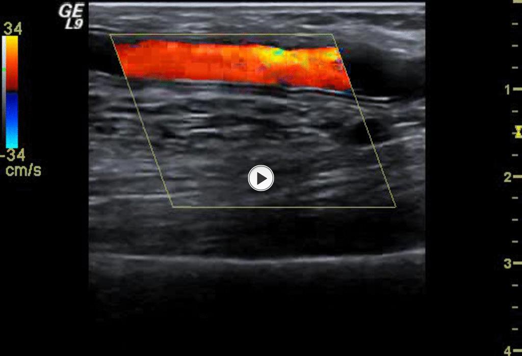 Fig.: 9. Normal graft. Notice the parallel echogenic lines that represent graft interface with the subcutaneous tissues and bloodstream.