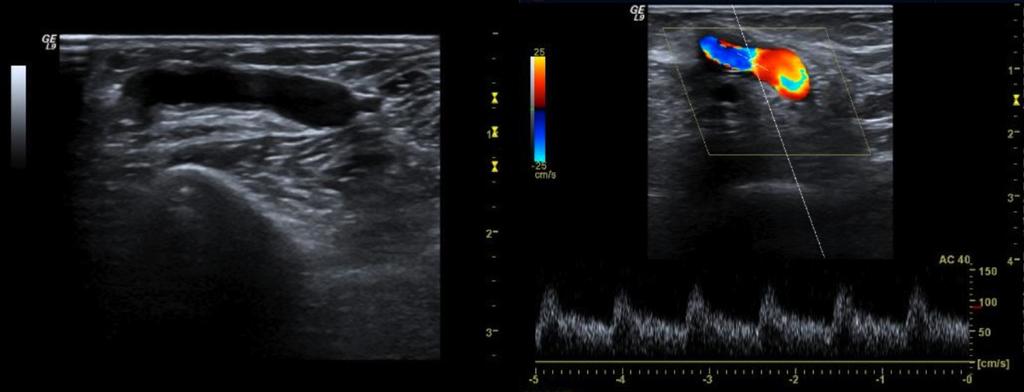 Fig.: 11. Normal AV radio-cephalic fistula anastomosis. Antegrade, low resistance arterialized flow. No morphologic evidence of stenosis.