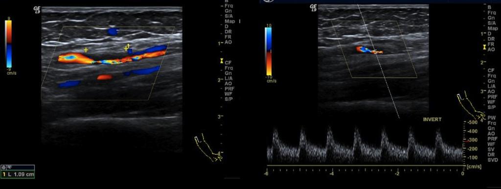 Fig.: 13. This particular patient had a hemodialysis session just prior to the ultrasound evaluation.