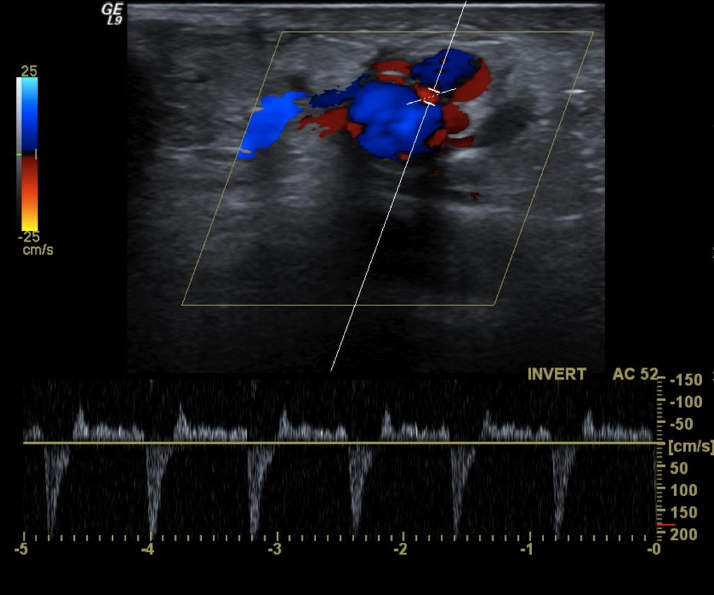 Fig.: 20. Typical "to and fro" waveform revealed in the spectral analysis. Ultrasound guided compression can be employed to thrombose the pseudoaneurysm.