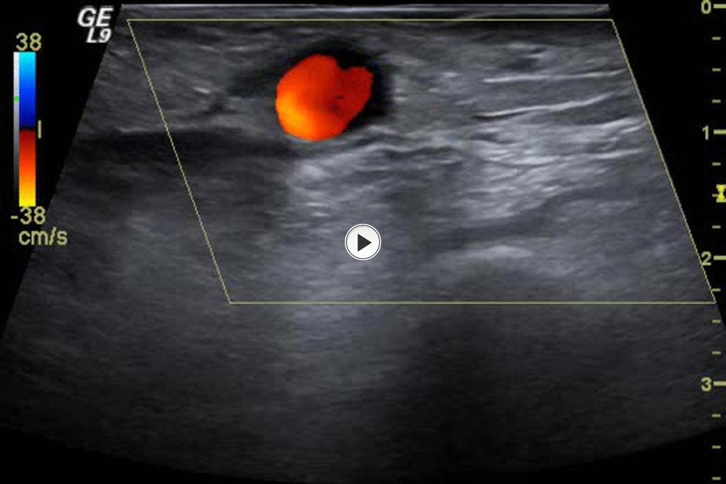 Fig.: 23. After 30 minutes of ultrasound guided compression there is no evidence of flow within the pseudoaneurysm.