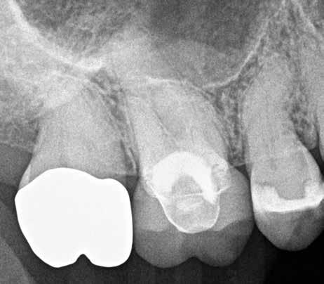 down before a periapical radiolucency will ever show up on an X-ray.