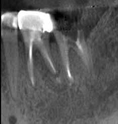 This is an example of a patient case where my cone beam helped me diagnose disease when my traditional testing and imaging are inconclusive.