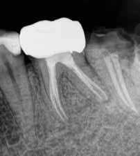 95, is an example of a patient with a failed root canal on tooth #19. The tooth has that typical J-shaped radiolucency around the distal root, and many would consider this tooth fractured.