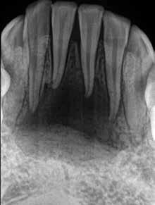 heal the tooth. Don t assume it s cracked and send it for extraction; it might not be cracked at all. So don t give up! As dentists, saving teeth is our game.