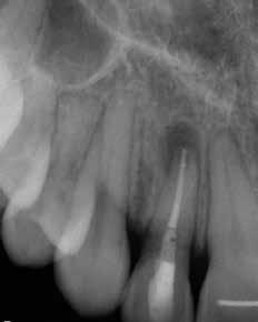Sometimes I see patients who have undergone an attempted root canal, but because I have incomplete records or information I use my cone beam to tell me the whole