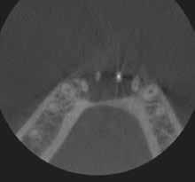 13) showed that there is actually a canal, and I could be confident when I access the tooth as long as I used the composite as my buccal border.