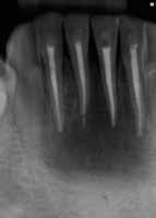 I found no response to cold in teeth #23 26, percussion tenderness only to #25, and no mobility of the teeth.