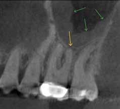 I confirmed my diagnosis of a necrotic pulp with asymptomatic apical periodontitis when I started to do the root canal.