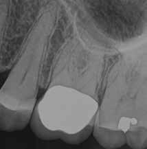 29: working length radiograph showing only three canals located).