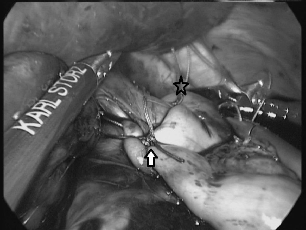 Figure 1. Intraoperative image of the wrap. The arrow indicates the first stitch, which includes the fundus, the esophagus, and the right crus.
