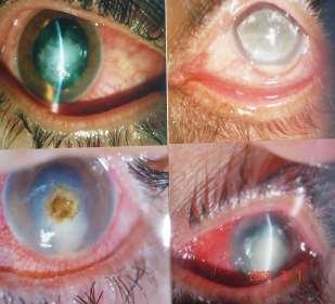 CASES OF FUNGAL KERATITIS Feathery margins Fungal plaque e hypopyon Corneal abscess Infitrates with