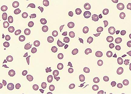 Peripheral blood smear of