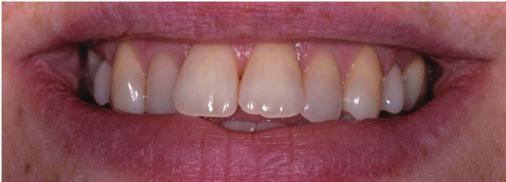 CLEAR SMILE ALIGNER Clear smile invisible aligners are the clear and simple cosmetic solution to