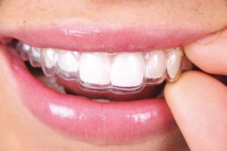 Made from water-thin medical grade plastic, the clear aligners are custom made specifically for