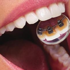 appliance that is placed at the back of your teeth.