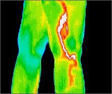 7. Thermography: the infrared imaging of the human body a real-time temperature measurement technique used to produce visualization of thermal energy emitted by the measured site at a temperature