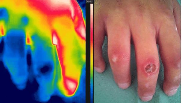 Thermography: the infrared imaging of the human body a real-time temperature measurement technique used to produce visualization of thermal energy emitted by the measured site at a temperature above