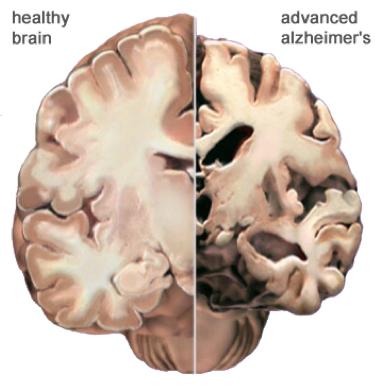2 Dementia Acquired brain disease characterized by a progressive decline in cognitive domains including: Attention Linguistic expression and comprehension Executive functioning skills Learning and