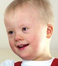 Health and development What are the more common health conditions in people with Down s syndrome?