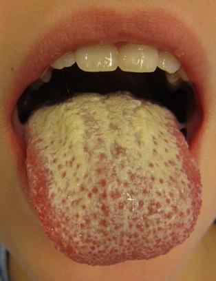 If gums get inflamed, it can enter the bloodstream and cause infection Oral Cavity Prevotella