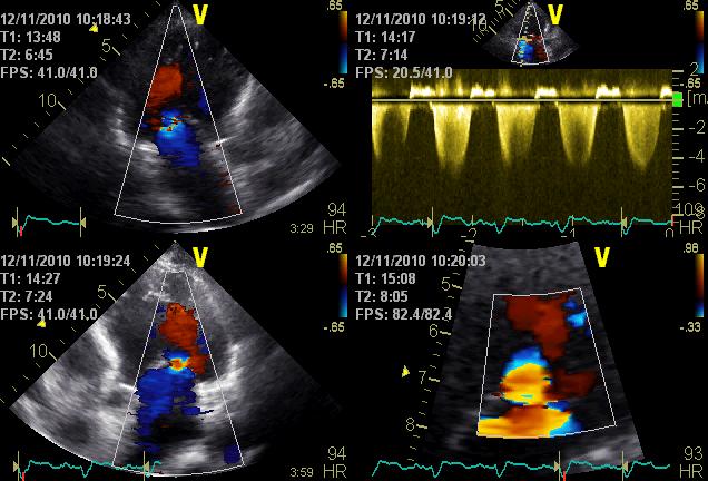 Exercise Doppler echo On full therapy 6 minutes 20 W (3 ), 40W (2 ), 50W(1 ) Stop because of dyspnea BP: 120/67 160/84 HR: 68 96 No arrhythmias or ST changes