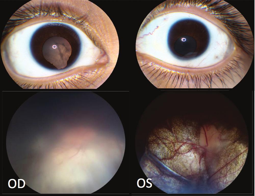 A B Figure 1. A 12-year-old girl with known history of canine ownership was seen for decreased vision in her right eye. She also had a known history of coloboma in each eye.