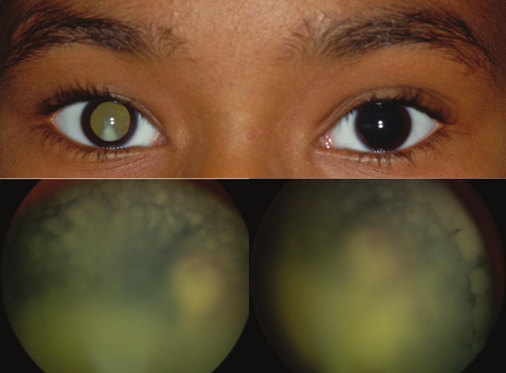 A B Figure 2. An 11-year-old girl was referred for evaluation of panuveitis and presented with decrease in vision in her right eye for 1 month.