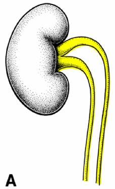 Double ureter Bifed ureter Ectopic ureter Caused by premature bifurcation of ureteric bud before