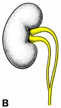 ureter Question: If the ureteric buds becomes the ureters and they are an outgrowth of