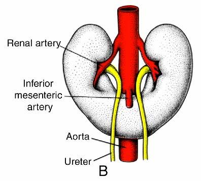 Horseshoe Kidney Abnormal fusion of lower poles of kidneys during ascent Ectopic position: ascent impeded by root of inferior mesenteric artery Occurs in ~1/600 individuals Usually asymptomatic with