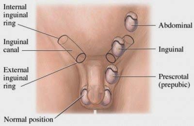 The testis descends into the iliac fossa close to the deep inguinal ring. 2.