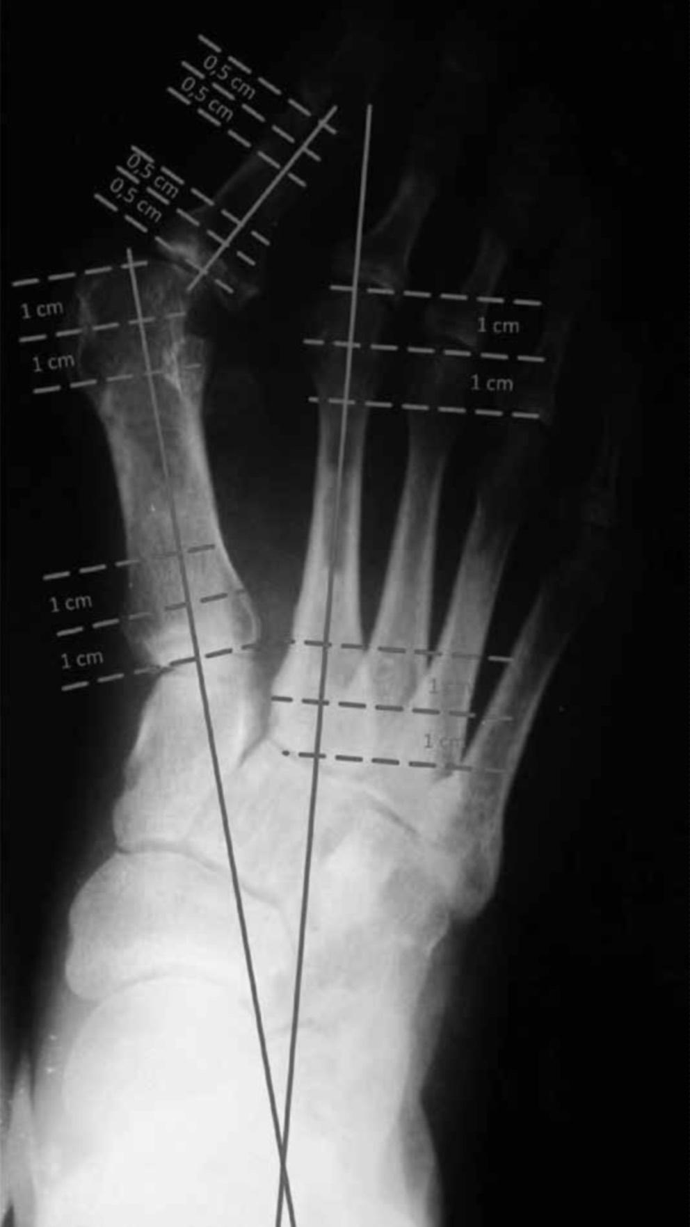 EVALUATION OF THE INTERMETATARSAL ANGLE AFTER THE ARTHRODESIS OF THE FIRST METATARSOPHALANGEAL 365 G0 G1 G2 G3 Figure 2 Severity of dislocation of the sesamoids.