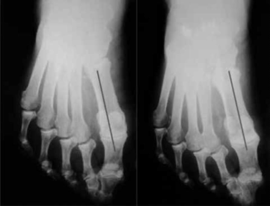 of its width; G2 the tibial sesamoid was cut by the axis used and more than 50% of its total mass was lateralized; and G3 when complete lateral dislocation of the glenosesamoid apparatus occurred.