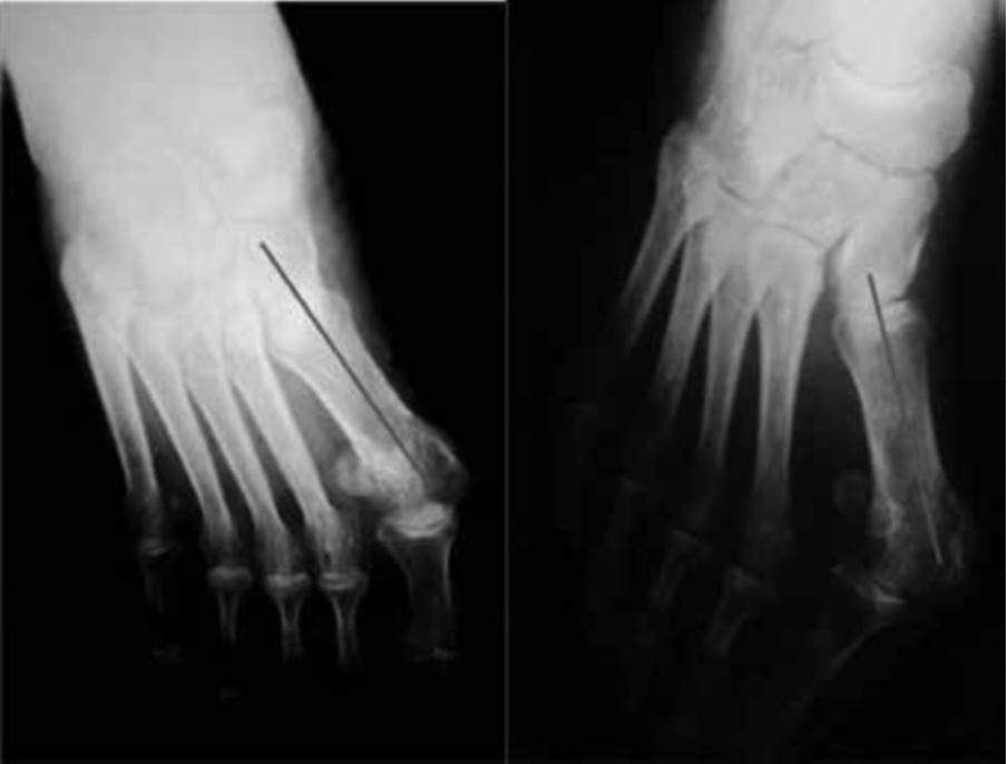 Because of the shorter length of the phalange, the reference points were placed 0.5 to 1 cm from the proximal and distal surfaces of the proximal phalange of the hallux.