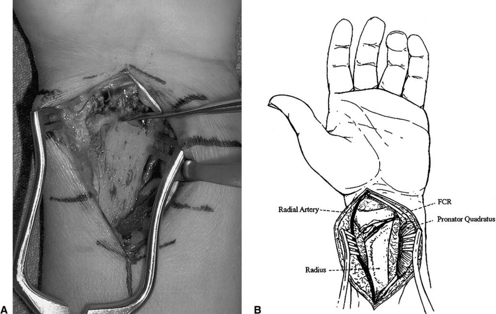 292 The Journal of Hand Surgery / Vol. 30A No. 2 March 2005 Figure 3. (A) Intraoperative view of surgical exposure of the volar radius. (B) Schematic drawing of volar wrist exposure.