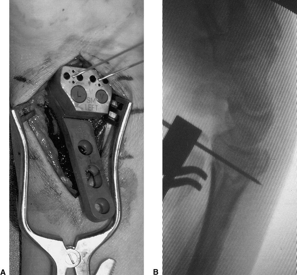 Wright, Horodyski, and Smith / Distal Radius Fractures and Volar ORIF 293 Figure 4. (A) Intraoperative view of the template in place.